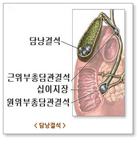 담낭결석