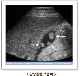 담낭용종 초음파