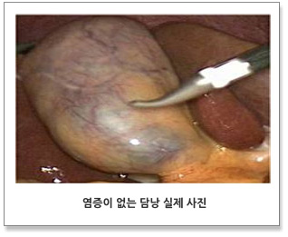 염증이 없는 담낭 실제 사진