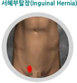 서혜부탈장(Inguinal Hernia)