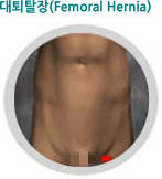 대퇴탈장(Femoral Hernia)