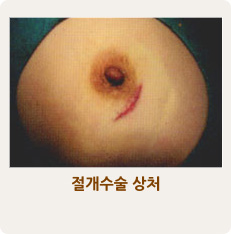 절개수술 상처