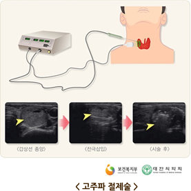 고주파 절제술